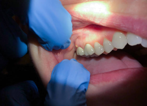 Best Emergency Dental Care for Broken or Chipped Teeth in Nashua, IA