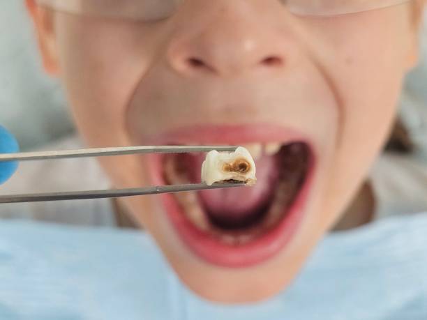 Best Emergency Tooth Extraction in Nashua, IA
